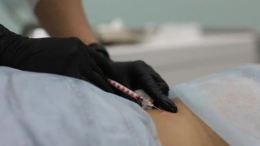 Kozmetik salonda benign tümör çıkarılması. Dermatolojide sıvı azot kullanımı.