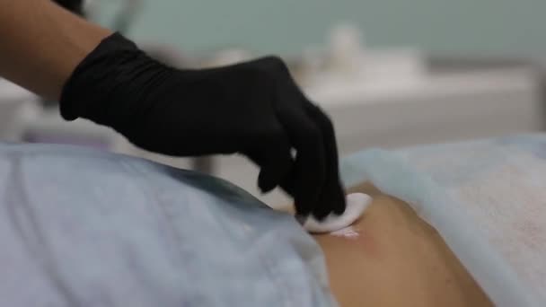 Verwijdering van goedaardige tumoren in Cosmeticastudio. Het gebruik van vloeibare stikstof in Dermatologie. — Stockvideo