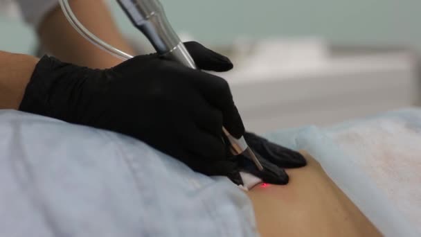 Borttagning av godartade tumörer i kosmetiska salong. Flytande kväve används i dermatologi. — Stockvideo