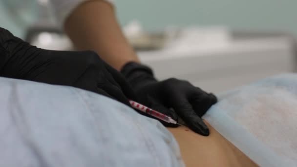 Borttagning av godartade tumörer i kosmetiska salong. Flytande kväve används i dermatologi. — Stockvideo