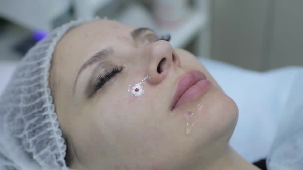 Косметолог в салоне красоты салон делает акне лечение с помощью механического инструмента. Концепция медицинского лечения омоложения и ухода за кожей . — стоковое видео