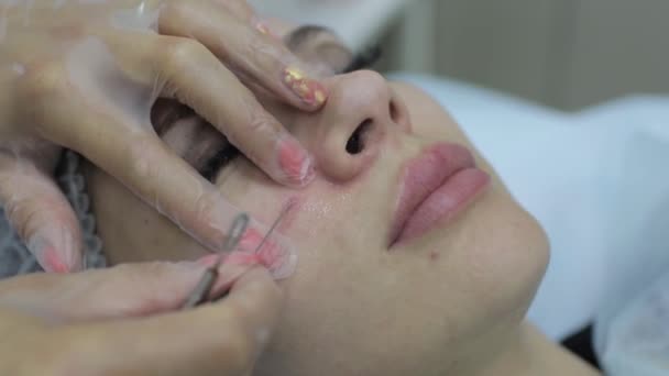 Cosmetologist στο spa σαλόνι ομορφιάς κάνει θεραπεία ακμής χρησιμοποιώντας μηχανικό μέσο. Έννοια της ιατρική θεραπεία αναζωογόνησης και περιποίηση δέρματος. — Αρχείο Βίντεο