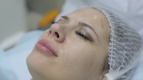 Rimozione dei punti neri dell'acne. Viso femminile, clinica di bellezza . — Video Stock