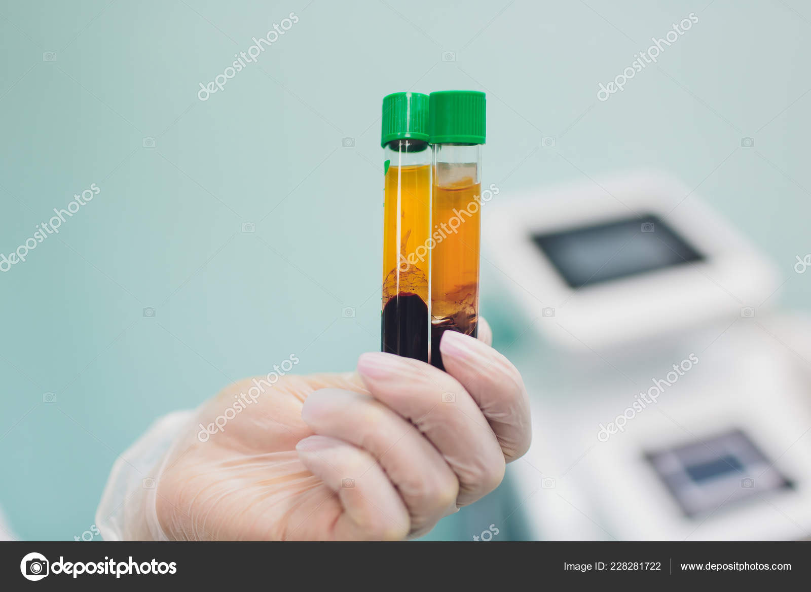 Preparing For Plasmolifting Blood Tubes In Two Layers Divided By