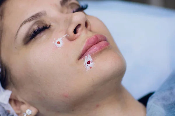 Rimozione dei punti neri dell'acne. Viso femminile, clinica di bellezza . — Foto Stock