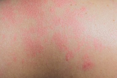 Anti döküntü, etrafında geri görünümü kadar insan dermatit sorunu döküntü, Anti döküntü ve sağlık sorunu olan kapatın.