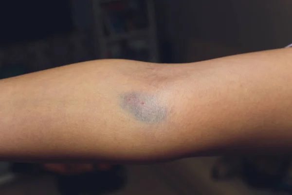 Bruises from blood collection isolated. Purple bruise on the arm. — Stock Photo, Image