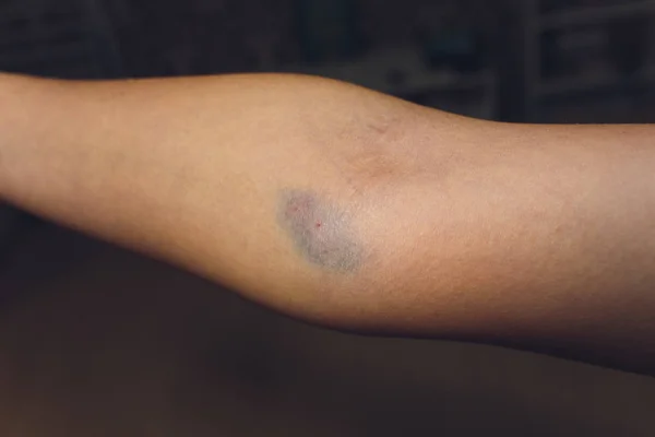 Bruises from blood collection isolated. Purple bruise on the arm. — Stock Photo, Image