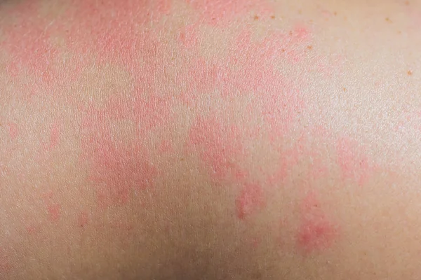 Närbild av allergi hudutslag, runt tillbaka syn på mänskliga med eksem problem av utslag, allergi hudutslag och hälsoproblem. — Stockfoto
