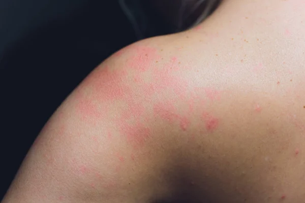 Закрыть аллергия сыпь, вокруг вид сзади человека с проблемой дерматита сыпь, аллергия сыпь и проблемы со здоровьем . — стоковое фото