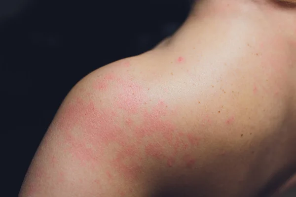 Närbild av allergi hudutslag, runt tillbaka syn på mänskliga med eksem problem av utslag, allergi hudutslag och hälsoproblem. — Stockfoto