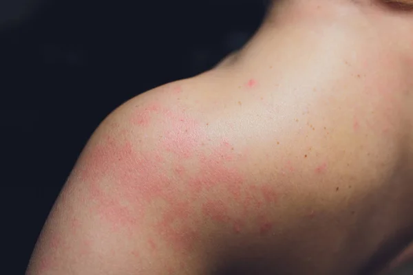 Close up Erupção cutânea alérgica, Em torno de Visão traseira do humano com problema de dermatite de erupção cutânea, Erupção cutânea alérgica e problema de saúde . — Fotografia de Stock