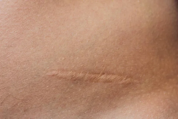 Cicatriz después de la cirugía. Antes después de la eliminación . —  Fotos de Stock