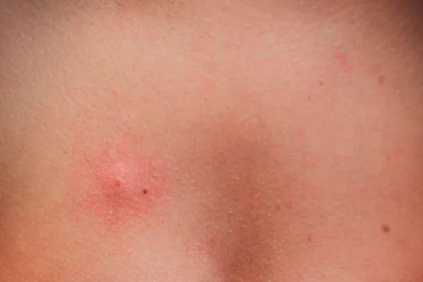 Bite with red rash on the skin close up — Stock Photo, Image