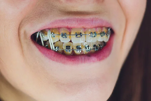 Dentes com aparelho dentário e elásticos boca cheia. amarelo, dentes sujos de café e cigarros — Fotografia de Stock