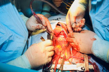 Doktor kalp operasyonu kalp nakli işlemi yapıyor