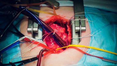 Doktor kalp operasyonu kalp nakli işlemi yapıyor