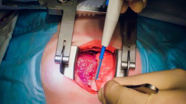 Doktor kalp operasyonu kalp nakli işlemi yapıyor