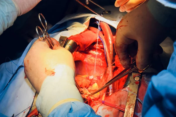 Doktor dělá transplantaci srdce operace srdce — Stock fotografie