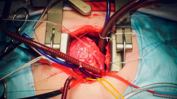 Médico haciendo operación de corazón operación de trasplante de corazón — Foto de Stock