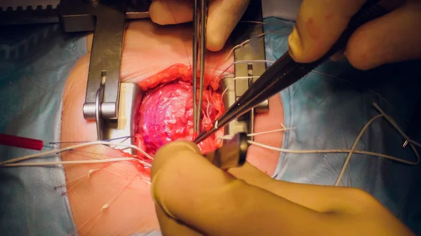 Doctor doing heart operation heart transplant operation — Stock Photo, Image