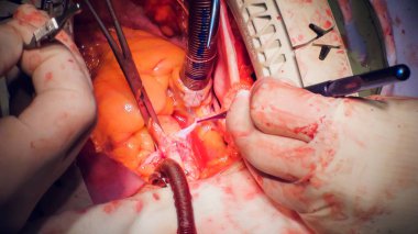 Doktor kalp operasyonu kalp nakli işlemi yapıyor