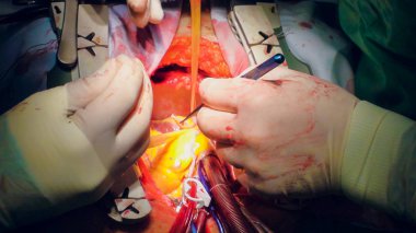 Doktor kalp operasyonu kalp nakli işlemi yapıyor