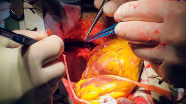 Doktor kalp operasyonu kalp nakli işlemi yapıyor