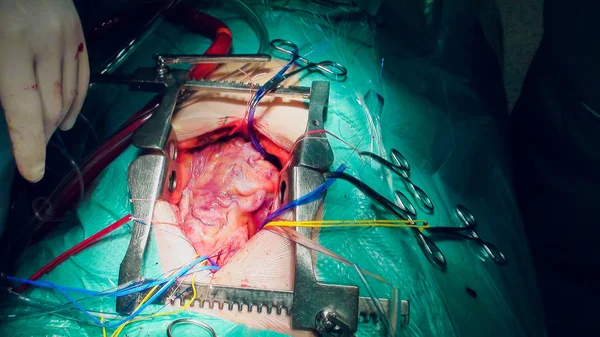 Médico fazendo operação de transplante cardíaco — Fotografia de Stock