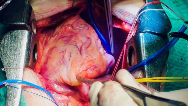 Médico fazendo operação de transplante cardíaco — Fotografia de Stock