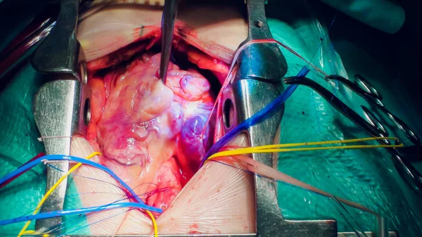 Doktor kalp operasyonu kalp nakli işlemi yapıyor — Stok fotoğraf