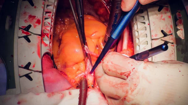 Dokter hart operatie hartoperatie transplantatie te doen — Stockfoto