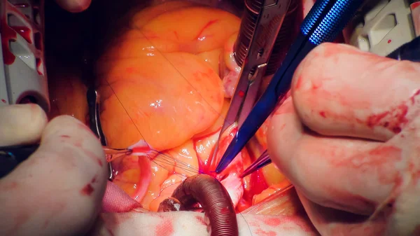 Médico fazendo operação de transplante cardíaco — Fotografia de Stock