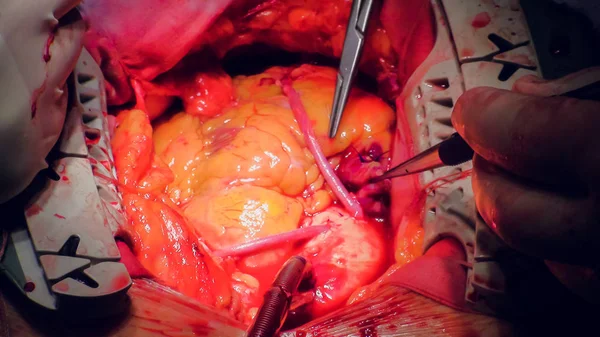 Лікар виконує операцію з трансплантації серця — стокове фото