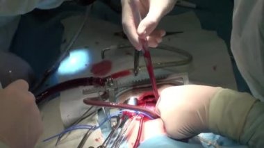 Doktor kalp operasyonu kalp nakli işlemi yapıyor