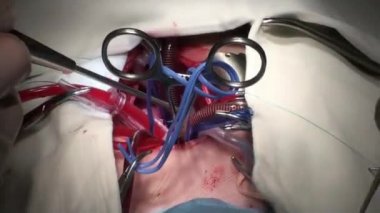 Doktor kalp operasyonu kalp nakli işlemi yapıyor