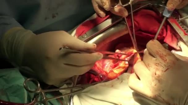 Doctor doing heart operation. Breastfeeding heart surgery — Stock Video