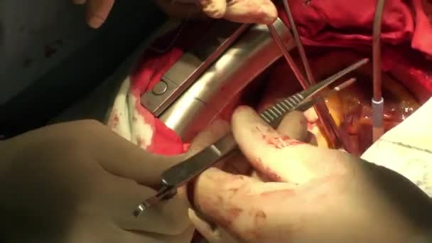Γιατρός Κάνει Εγχείρηση Μεταμόσχευσης Καρδιάς Λειτουργία — Αρχείο Βίντεο