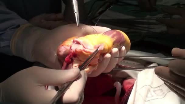 心操作心臓移植手術を行う医師 — ストック動画