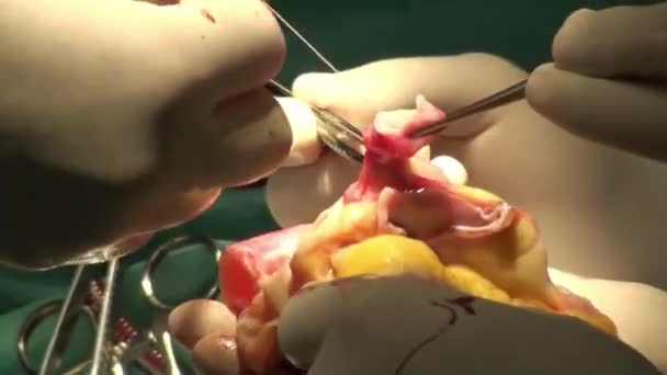 Лікар виконує операцію з трансплантації серця — стокове відео