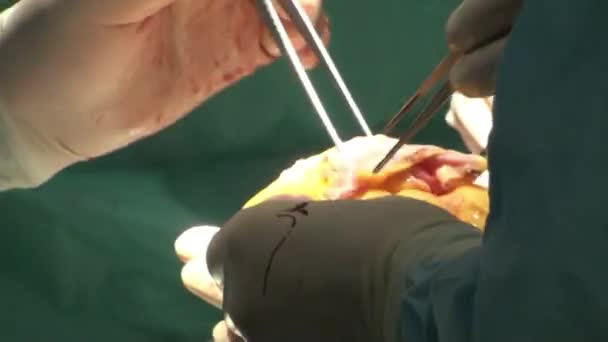 Médecin faisant une opération cardiaque opération de transplantation cardiaque — Video