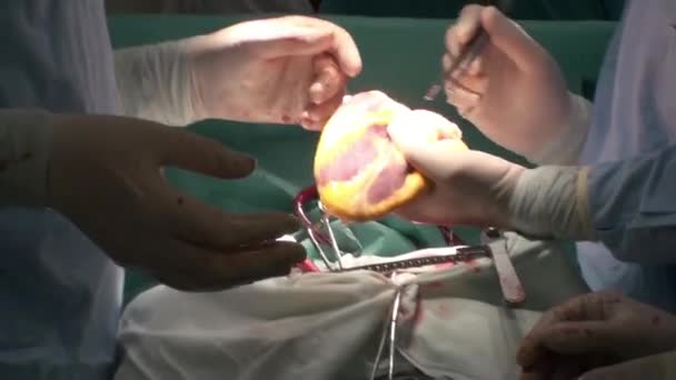 Врач проводит операцию по пересадке сердца — стоковое видео