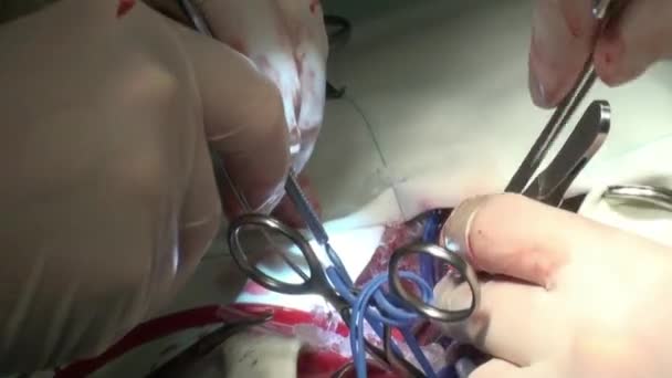 Врач проводит операцию по пересадке сердца — стоковое видео