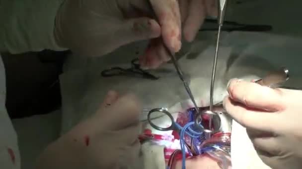 Arzt bei Herzoperation Herztransplantation — Stockvideo
