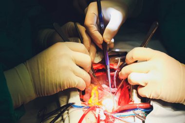 Kalp cerrahisi işlemidir. Kalp ameliyatı.