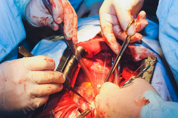 Le processus de chirurgie cardiaque. La chirurgie cardiaque . — Photo