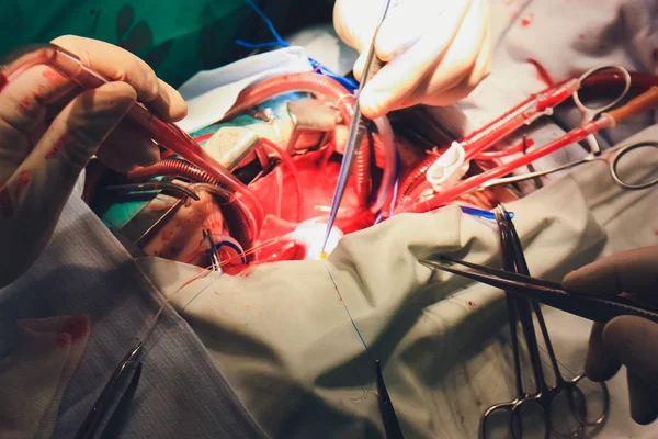 Proces srdeční chirurgie. Operace srdce. — Stock fotografie
