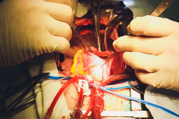 Le processus de chirurgie cardiaque. La chirurgie cardiaque . — Photo