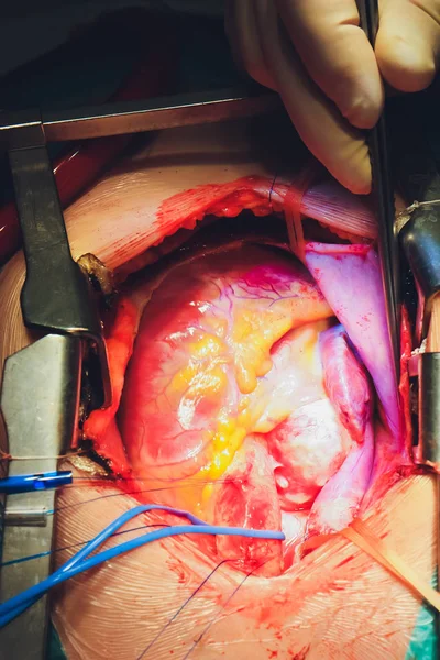 Процесс кардиохирургии. Операция на сердце . — стоковое фото