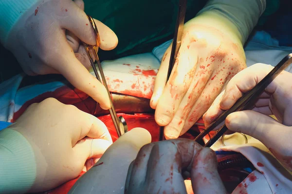 Λεπτομέρεια από μια χειρουργική επέμβαση στο χειρουργείο του νοσοκομείου. — Φωτογραφία Αρχείου